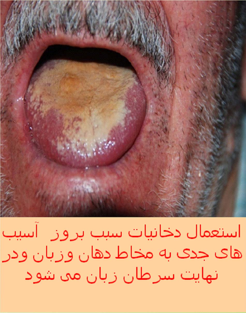 Iran 2009 Health Effects Mouth - tongue cancer, gross